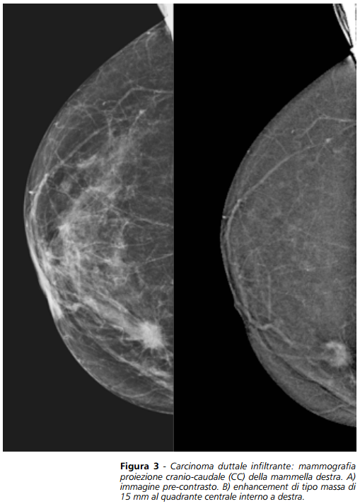 mammografia3