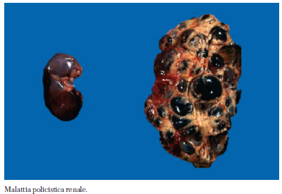 policistica Figura 1