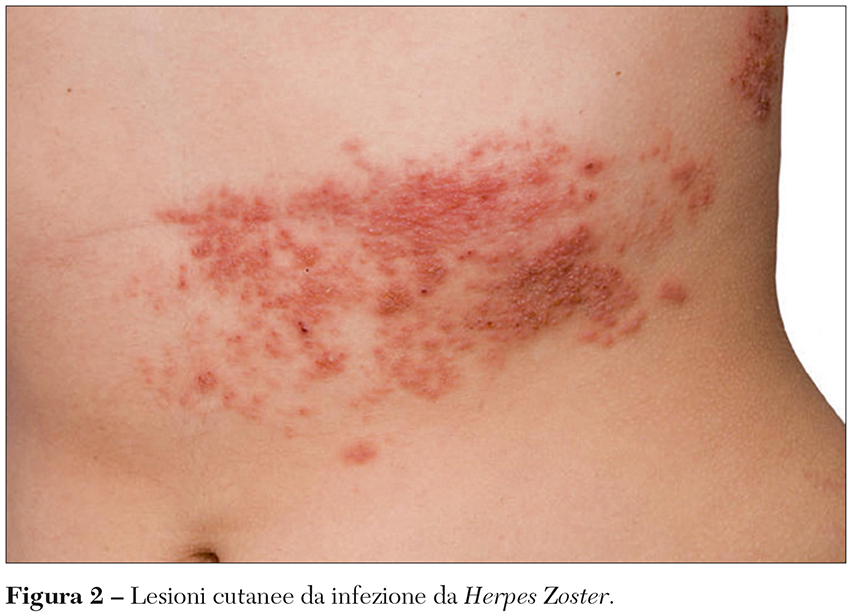 herpes Fig 2