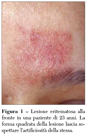 Fig 1 Lesione eritematosa