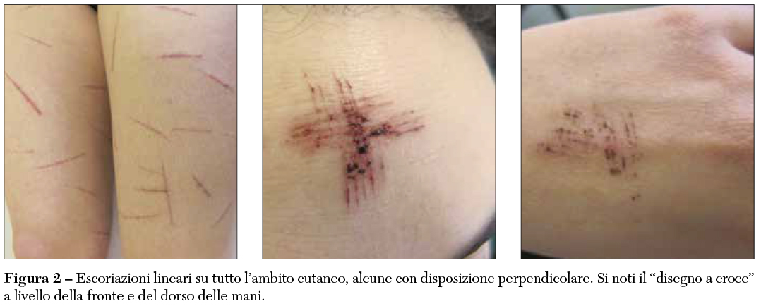 Fig 2 Escoriazioni lineari