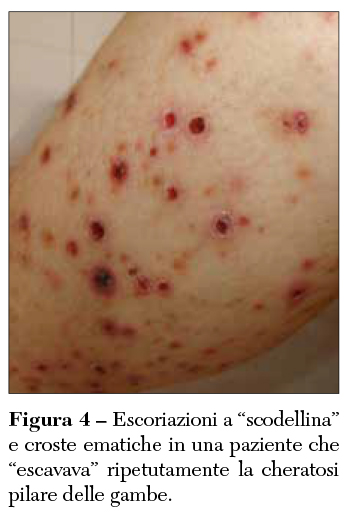 Fig 4 Escoriazioni scodellina