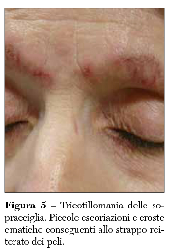 Fig 5 Tricotillomania