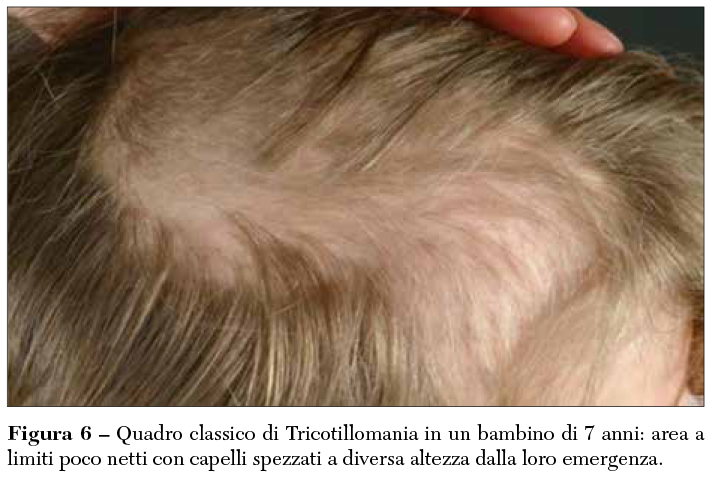 Fig 6 Tricotillomania