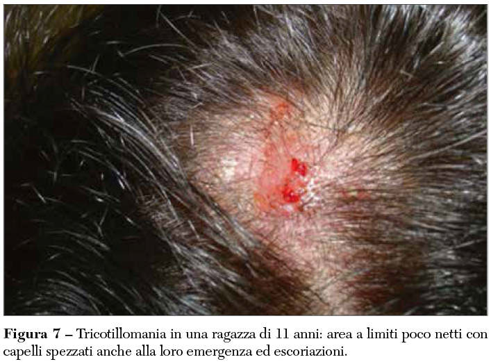 Fig 7 Tricotillomania