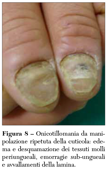Fig 8 Onicotillomania