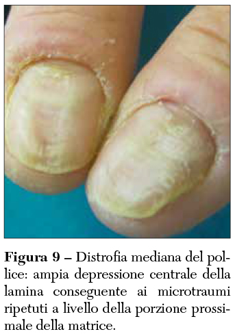 Fig 9 Distrofia
