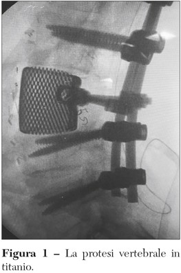 protesi vertebrale titanio