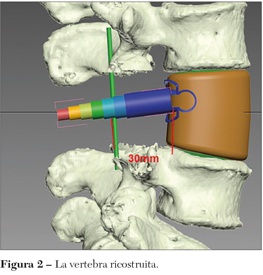 vertebra ricostruita