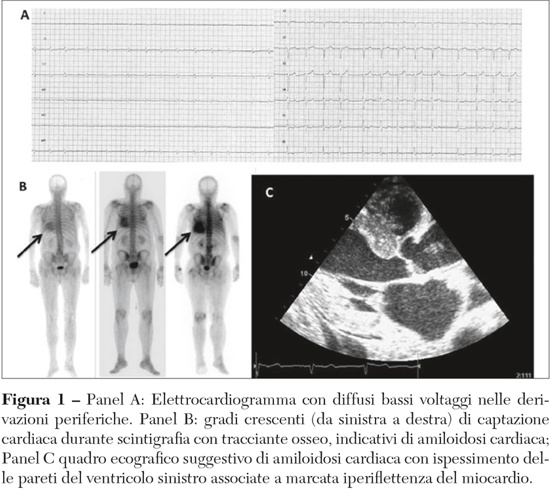 Elettrocardiogramma con voltaggi